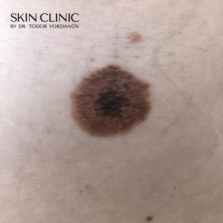 Невус (бенка) - Combined targetoid nevus