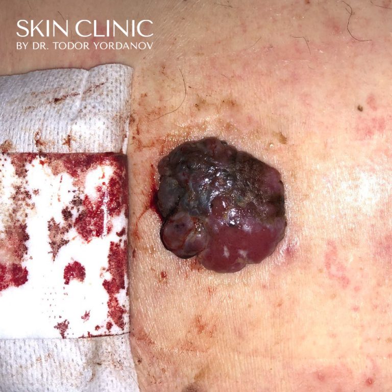 Малигнен меланом (Melanoma malignum)