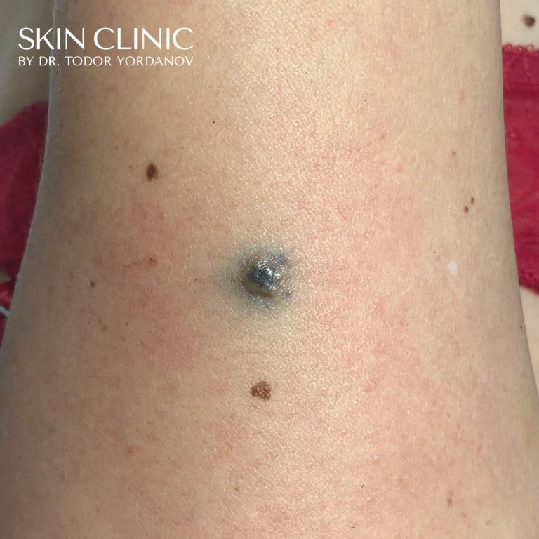 Синя бенка (Blue nevus)