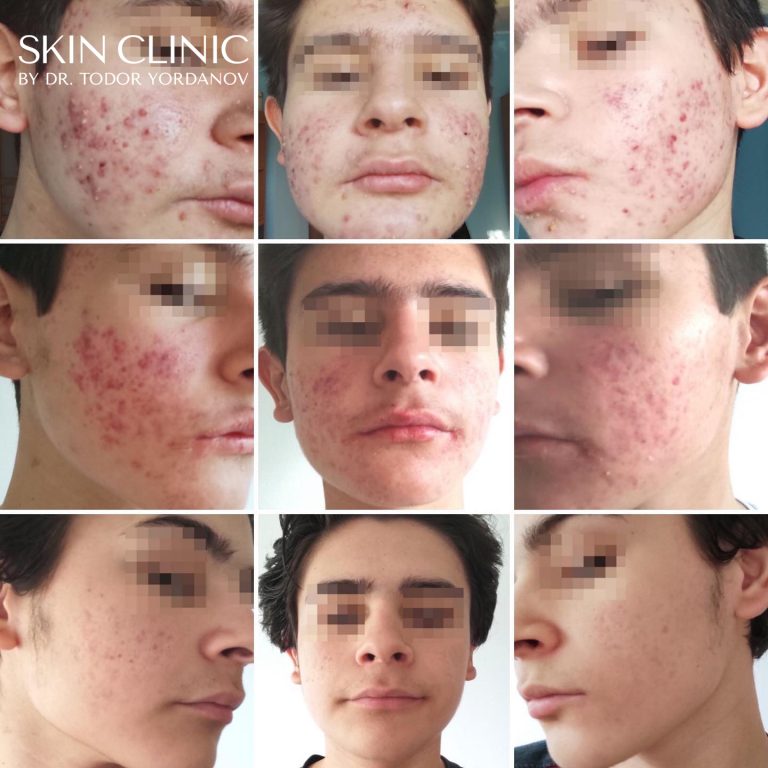 Тежка форма на акне (acne conglobata)
