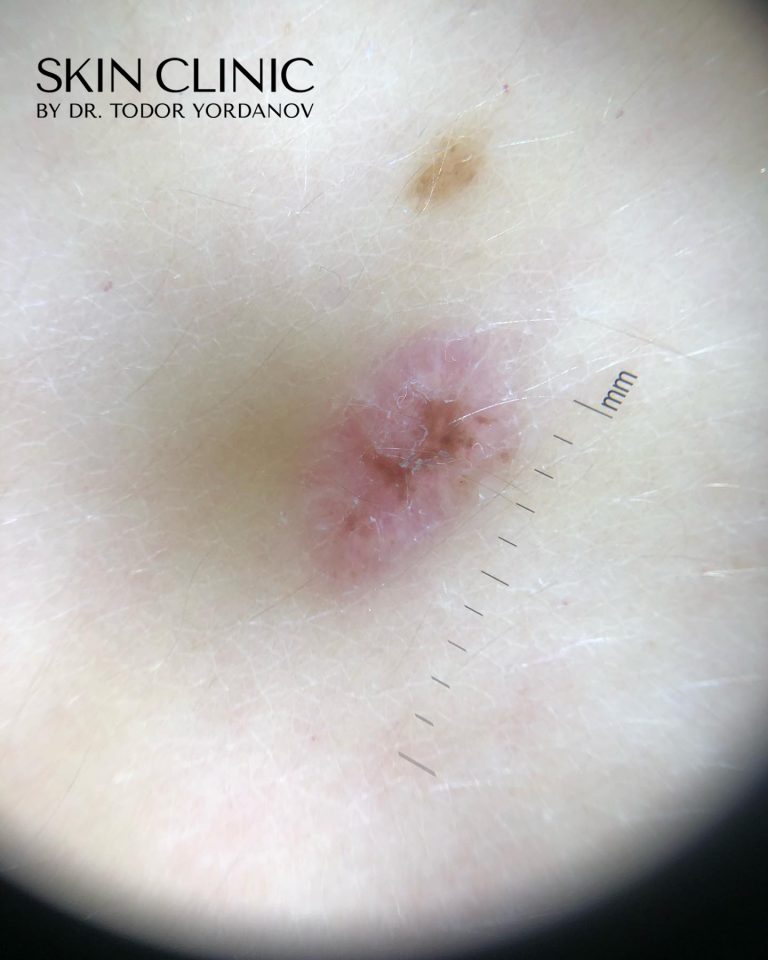 Рецидивираща бенка или Pseudomelanoma