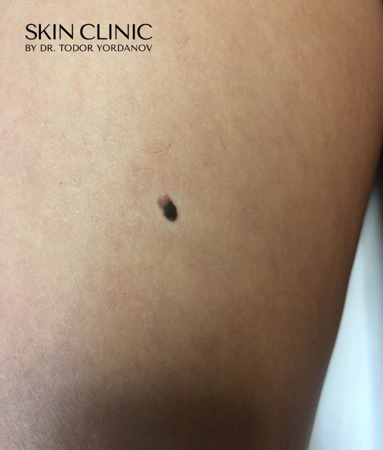 Малигнен меланом (Melanoma malignum)