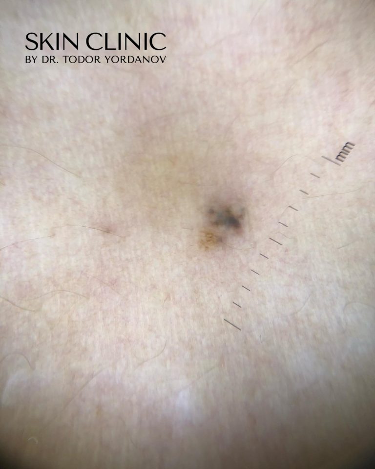 Рецидивиращ невус или Pseudomelanoma