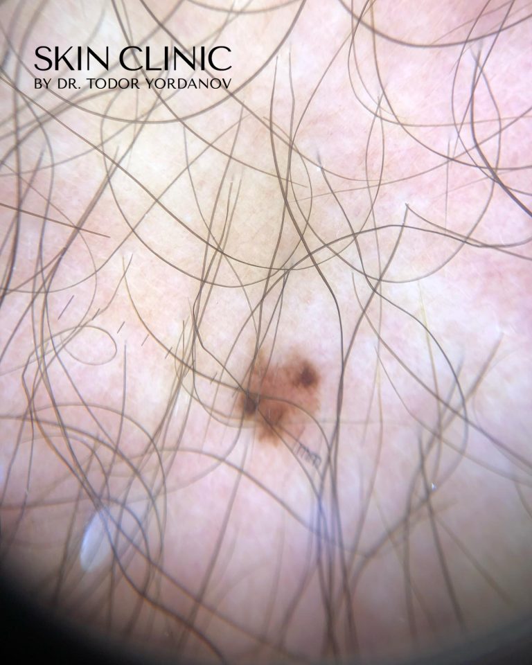 Малигнен меланом (Melanoma malignum)