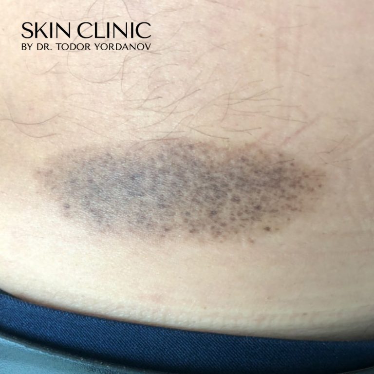 Nevus spilus или Speckled lentiginous nevus