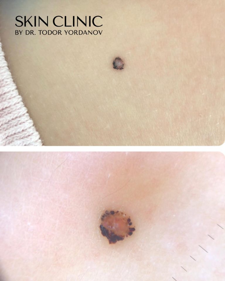 Spirz тумор или nevus Spitz