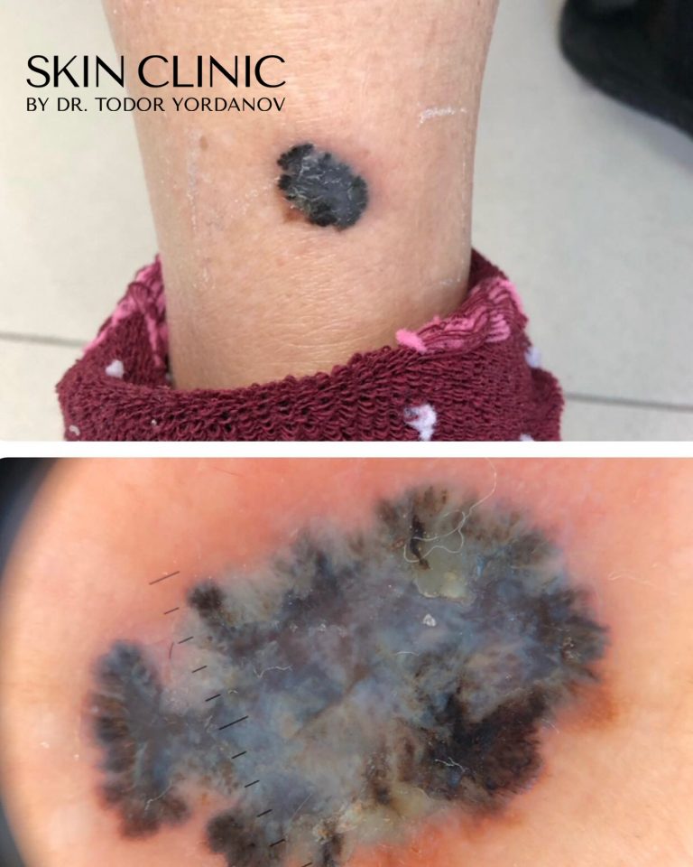 Малигнен меланом (Melanoma malignum)