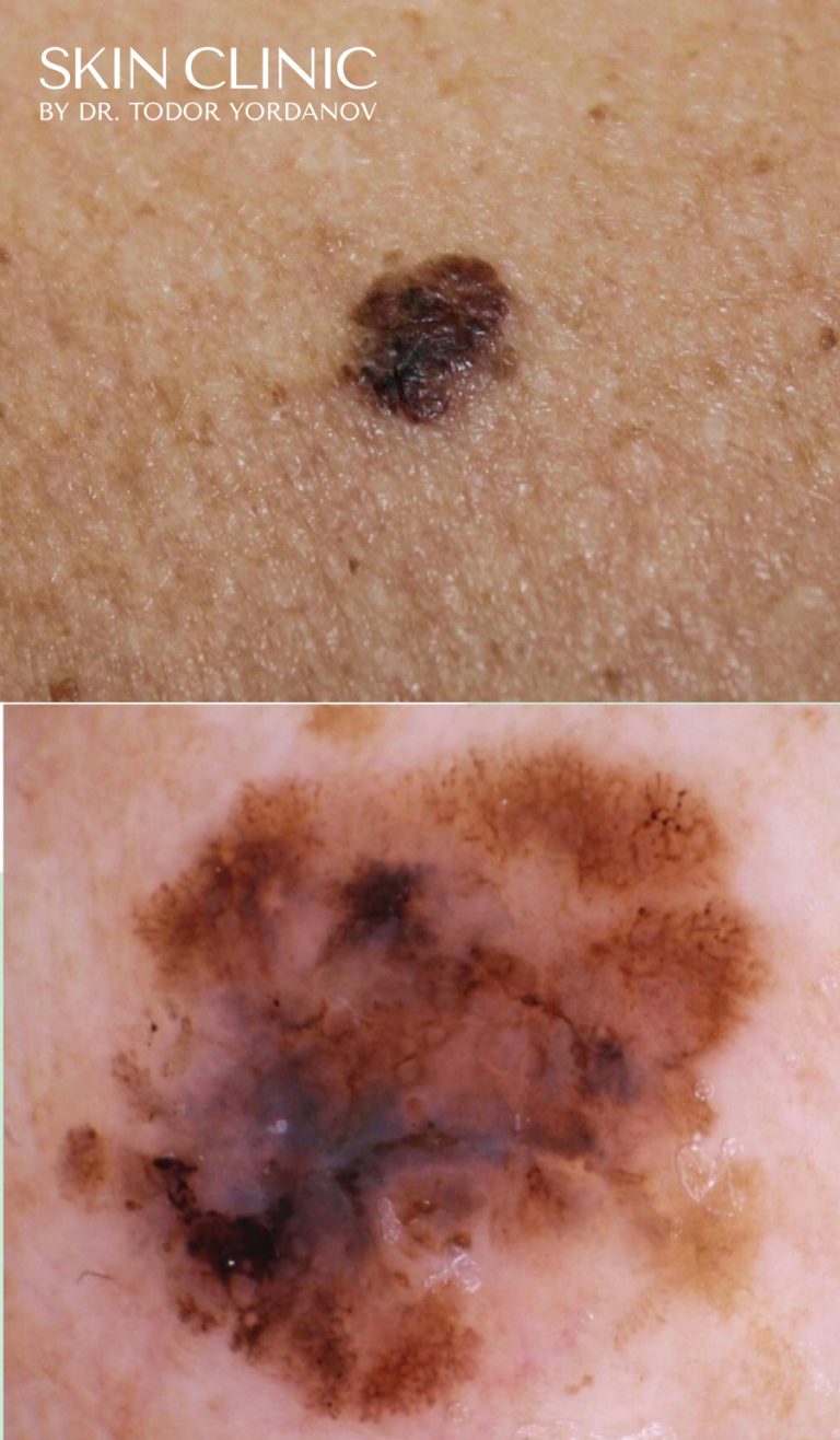 Малигнен меланом (Melanoma malignum)