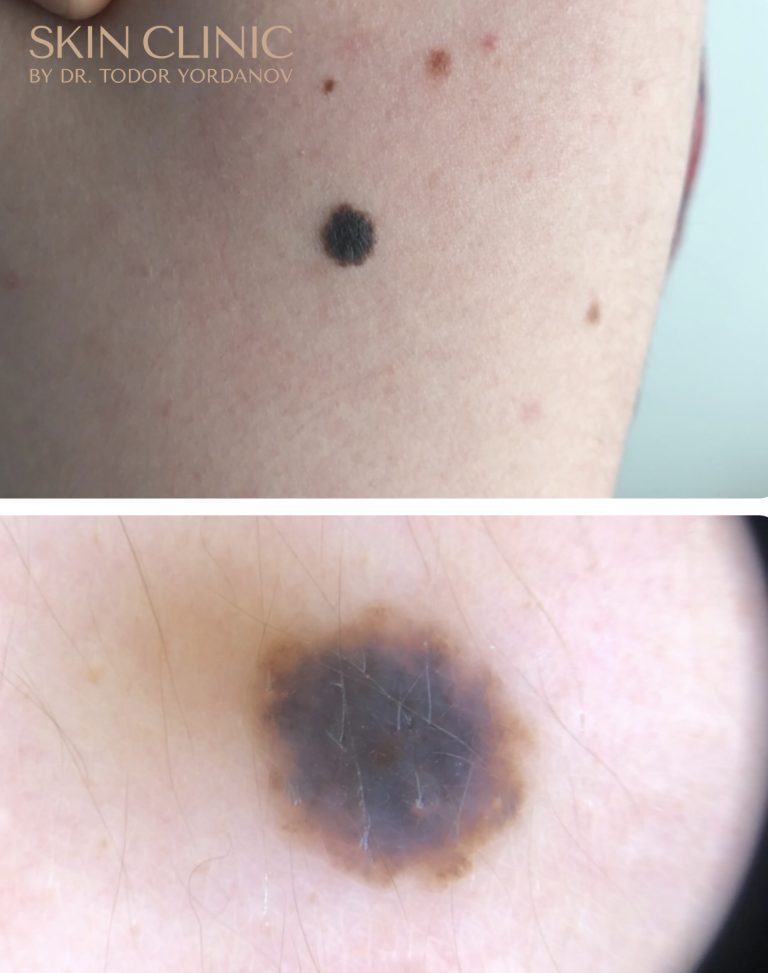 Дипластичен невус (nevus dysplasticus)