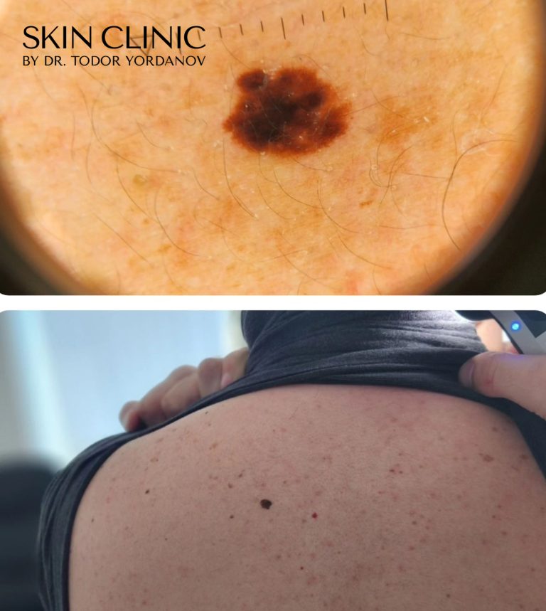 Дипластичен невус (nevus dysplasticus)