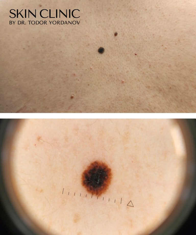 Melanoma in situ