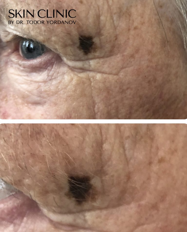 Lentigo maligna melanoma