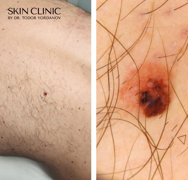 Melanoma in situ