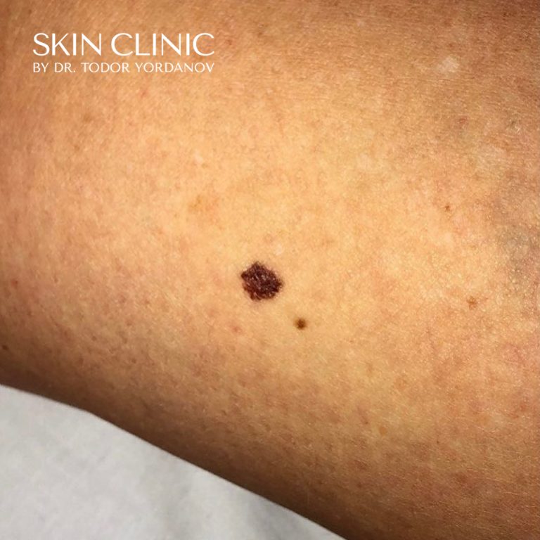 Малигнен меланом (Melanoma malignum)