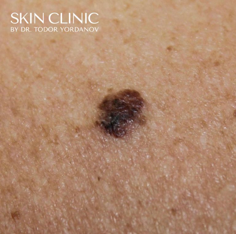 Малигнен меланом (Melanoma malignum)